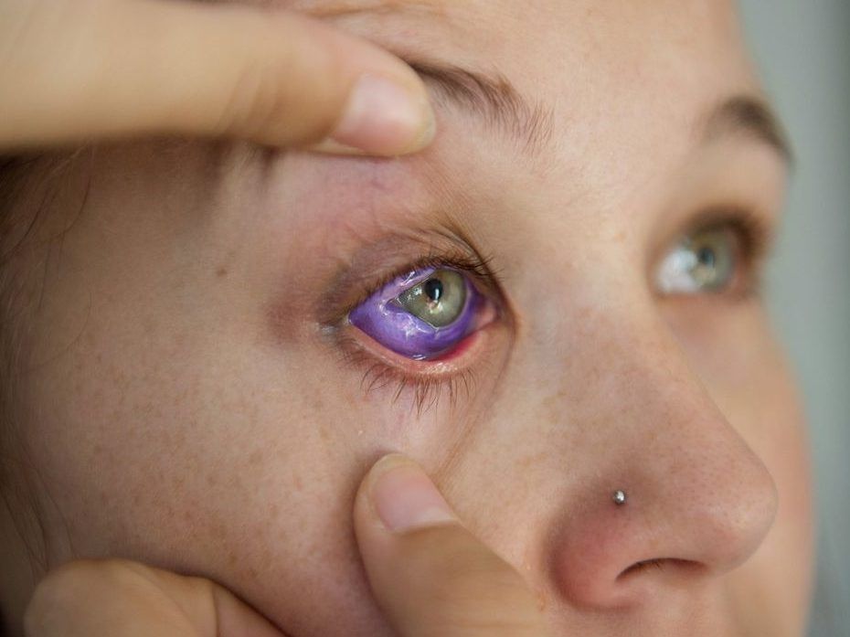 Eyeball Tattoos Banned In Indiana Months After Ottawa Womans Botched
