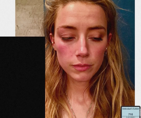Amber Heard testified that Johnny Depp hurt her face in one of many battles.