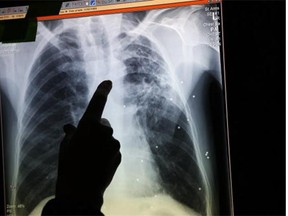 The health system will need to cover the cost of treating complex tuberculosis cases, according to a report.