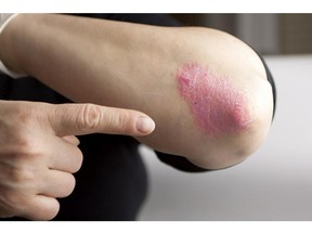 Eczema can become worse when dry, cold weather sets in.