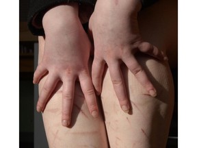 Edmonton -  Feb. 13, 2006 - Photo of a young woman's legs, at her psychologist's office, who has self-injuries and has bad cuts/scars. For cutting and self injury Ed story by Elizabeth Withey running Feb. !8, 2006. Photo by Ed Kaiser-Edmonton Journal/CanWest News Service *CALGARY HERALD MERLIN ARCHIVE*