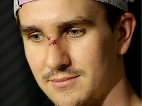 Calgary Flames Mikael Backlund sports a few stitches on the bridge of his nose as he talks to the media on Friday after taking a pounding in Game 5 in Vancouver.