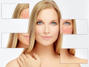 Moisturizers, sunscreens and IPL treatments can reduce the redness associated with rosacea.