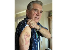 Dave Loeppky in his northeast Calgary home in Calgary, Alberta Tuesday, October 1, 2013. He was allegedly attacked by a police dog last week, after he made a reference to a gun during a 911 call.