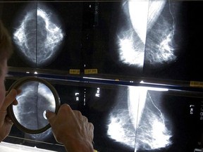 A radiologist uses a magnifying glass to check mammograms for breast cancer in Los Angeles on May 6, 2010. A new study says women with early stage breast cancer are getting unneeded follow-up imaging tests that are clogging up the health-care system and wasting millions of dollars. THE CANADIAN PRESS/AP - Damian Dovarganes