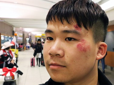 Rui Jhao shows his badly bruised head after he was slammed into a wall while on an Air Canada Boeing 777 from Shanghai to Toronto which experienced severe turbulence. The plane was diverted to Calgary.