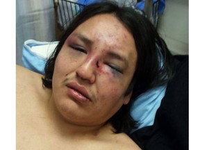 Christian Duckchief, 23, in a photo taken by family in hospital in Calgary over the weekend following his arrest by RCMP on Friday, April 1 in Siksika.