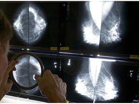 In this May 6, 2010 file photo, a radiologist uses a magnifying glass to check mammograms for breast cancer.