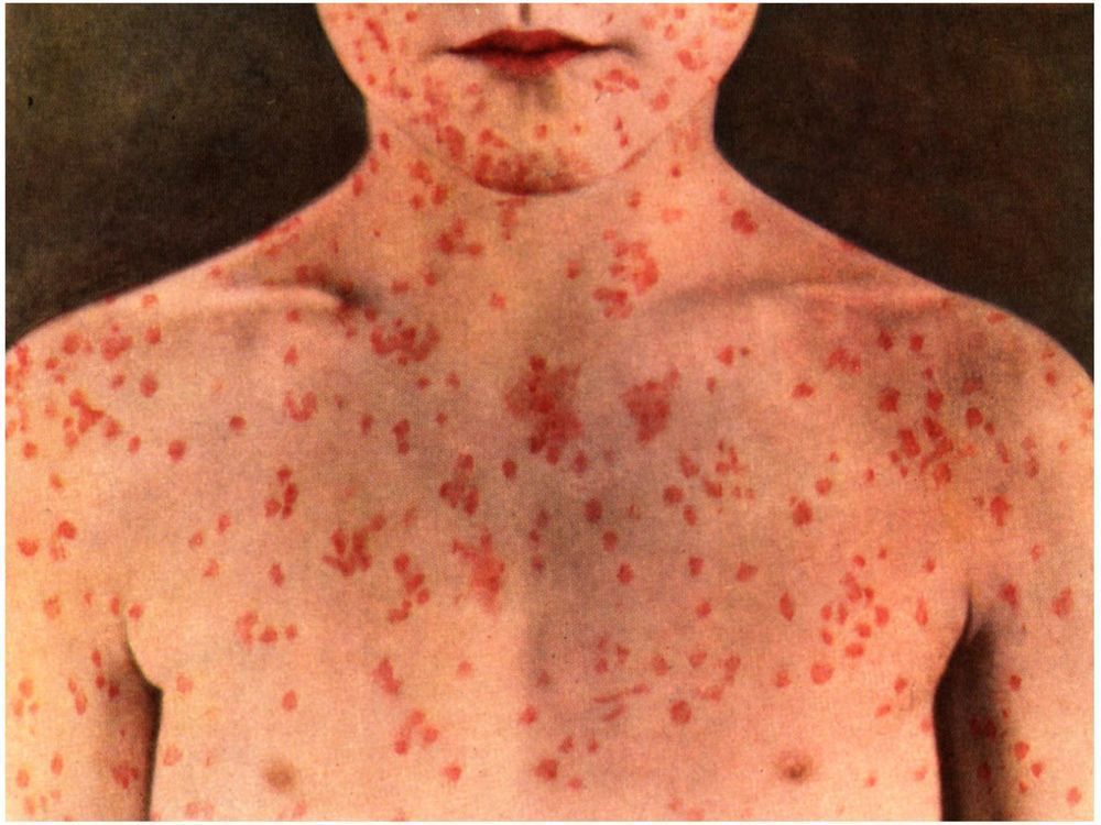 Measles case at south Calgary grocery store triggers public alert