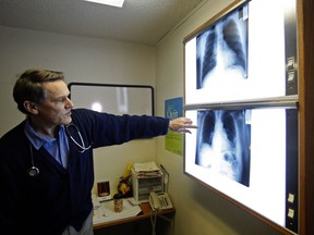 FILE -  In this Feb. 18, 2010 file photo, Dr. Brad Black, director of the Libby, Mont., asbestos clinic, looks at X-rays. A long-delayed risk study released Monday, Dec. 8, 2014 for the Montana mining town where hundreds have died from asbestos exposure concludes that even a minuscule amount of the substance can lead to lung problems. The 328-page draft document will guide the remaining cleanup of asbestos dust from a W.R. Grace & Co. vermiculite mine outside Libby, a town of 2,600 people located about 50 miles south of the Canada border. The scenic mountain community has become synonymous with asbestos dangers since news reports 15 years ago first drew attention to the number of people dying from exposure.