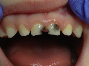 Calgary dentists and orthodontists are distressed about what they are increasingly seeing in their dental chairs.