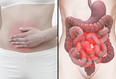 November is Crohn's and Colitis Awareness Month in Canada. The CALM study, which involved the IBD Clinical Trials Unit at the University of Calgary, has found that a "tight control" approach informed by biomarkers can improve outcomes in this disease.