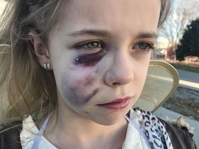 Nine-year-old Bella Willoughby shows the wounds sustained after she was attacked by a pit bull in High River on Oct. 30, 2018. (submitted)