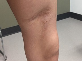 A dog-bite shaped wound is visible on Lorraine Cardinal's leg. Police service dog Fozzy bit her during an arrest in 2015. The officers involved in the arrest were cleared of disciplinary charges on Oct. 30, 2020.