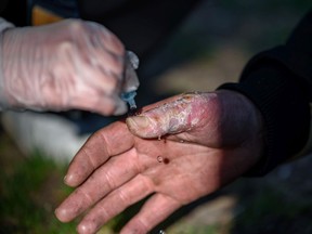 Olivia Levy helps treat Dustin McKeeman's frozen hands.