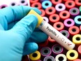 Syphilis is in the rise but there are new tests for the STD. Getty Images
