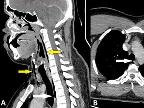CT scans of the neck and thorax. White arrows point to the tracheal tear at the level of the third and fourth thoracic vertebrae and yellow arrows point to the surgical emphysema of the patient's neck.