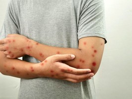 measles