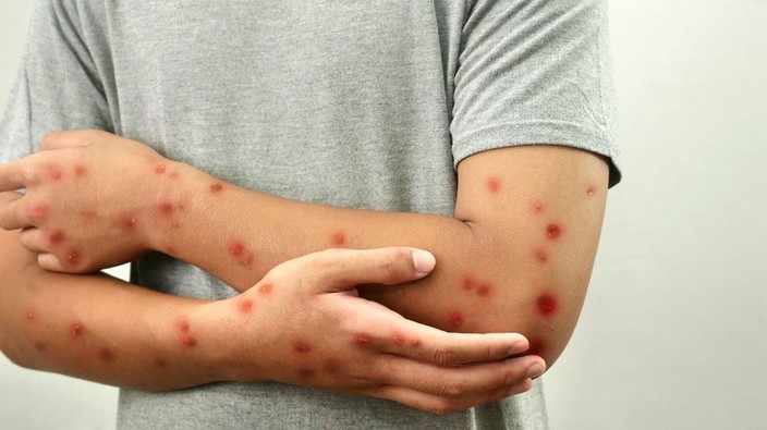 Ford: There is no 'right' to put kids at risk from measles