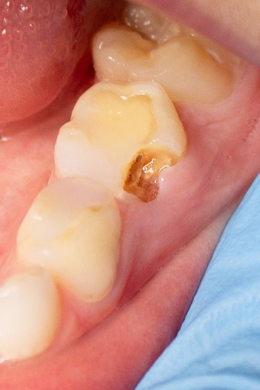 Why you should care about childhood tooth decay Why you should care about childhood tooth decay