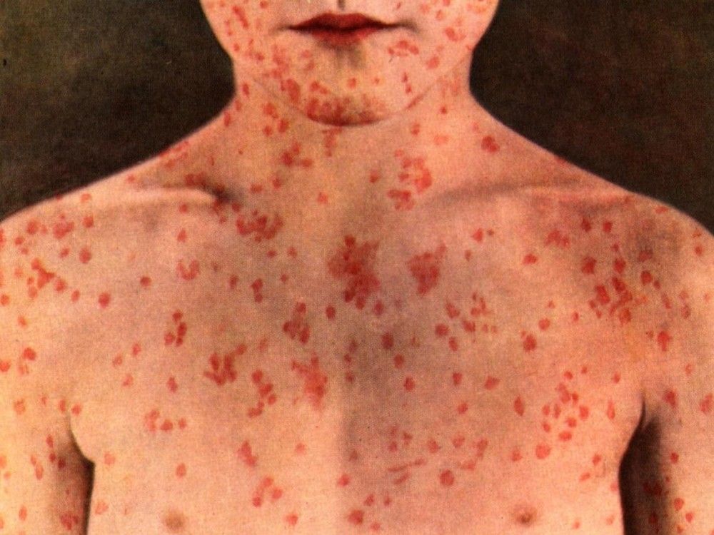 Measles case confirmed north of Calgary as health officials warn of possible exposure