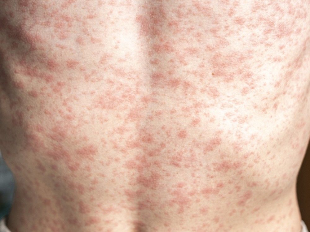 052225-measles_rash