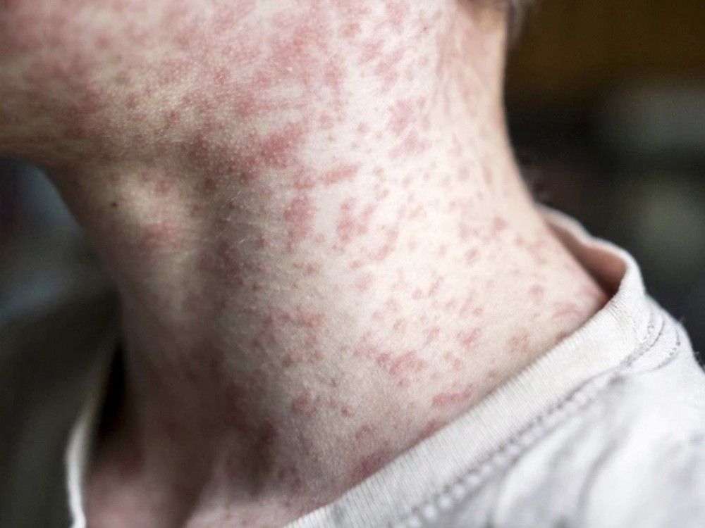 AHS confirms a second case of measles at the Stollery Children's Hospital
