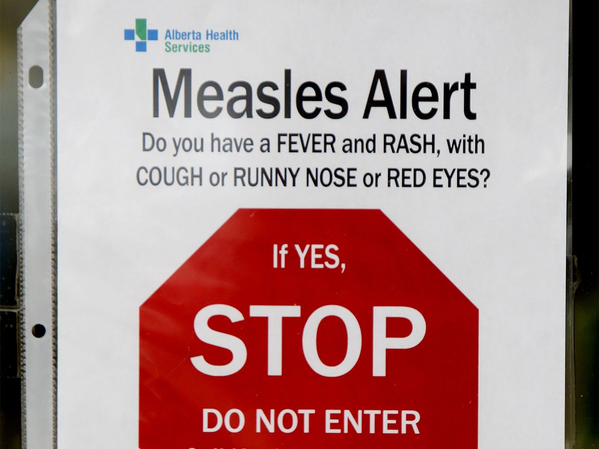 A measles exposure alert has been issued for those who were in the Foothills Medical Centre or Alberta Children's Hospital emergency rooms.