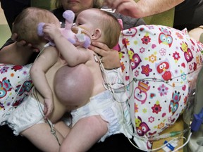 In this Jan. 13, 2018, photo provided by Texas Children's Hospital in Houston, Jill and Michael Richards along with their two sons, Collin and Seth, spend time together with their conjoined twins, Anna and Hope Richards, before successful surgery to separate the toddler girls. The two were born in 2016 conjoined at the chest and abdomen. (Paul Vincent Kuntz/Texas Children's Hospital via AP)