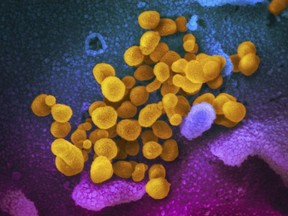 The Novel Coronavirus SARS-CoV-2, yellow, emerges from the surface of cells, blue/pink, cultured in the lab from a patient in the U.S. in a February 2020 electron microscope image made available by the U.S. National Institutes of Health.