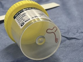 This undated photo supplied by Canberra Health Services, shows a parasite in a specimen jar at a Canberra hospital in Australia. A neurosurgeon investigating a patient's mystery neurological symptoms in an Australian hospital has been surprised to pluck a 3-inch wriggling worm from her brain.