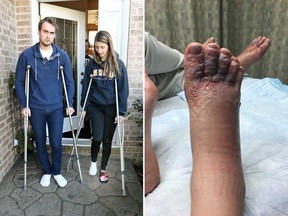 Windsor residents Eddie Zytner and his girlfriend Katie Stephens need crutches after both contracted the parasitic condition called cutaneous larva migrans - hookworms - on a vacation in the Dominican Republic in January 2018.