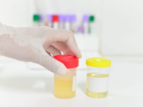 In this stock photo, a lab technician examines urine samples.
