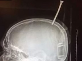 A 13-year-old Maryland boy survived after getting a six-inch screw lodged in his skull. (YouTube/CBSDFW)