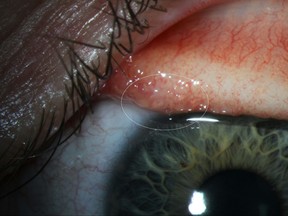 This August 2016 photo provided by Oregon Health & Science University (OHSU) shows inflammation (in the circle added by the source) from the infection caused by Thelazia gulosa, a type of eye worm seen in cattle in the northern United States and southern Canada, inside of the eyelid of a woman. (OHSU via AP)