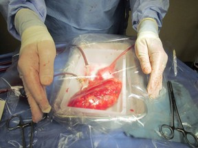 A kidney is seen during a transplant in this undated handout photo.
