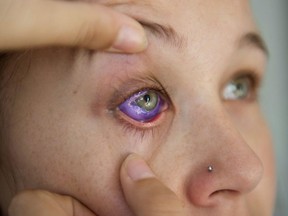 Catt Gallinger, who had a botched ink injection in her eyeball, shows the amount of swelling in her eye, at home in Ottawa on Friday, Sept. 29, 2017. Medical professionals and body artists say the practice of tattooing the eyeball, which recently left an Ottawa woman facing the prospect of vision loss, is on the rise despite its many risks.