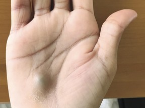 A Vancouver man developed this bizarre lump on his right hand after a routine visit to the dentist.