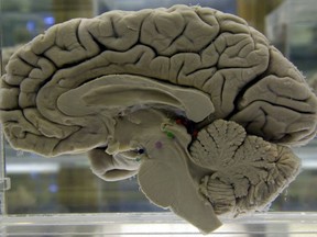 A section of a preserved human brain on display at the Museum of Neuroanatomy at the University at Buffalo, in Buffalo, N.Y. on Tuesday, Oct. 7, 2003. (AP Photo/David Duprey)