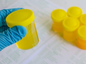 In this stock photo, a lab technician examines urine samples.