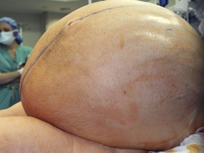 In this February 2018 photograph provided by the Danbury Hospital, a large tumor is prepared to be removed from a patient at the hospital in Danbury, Conn.