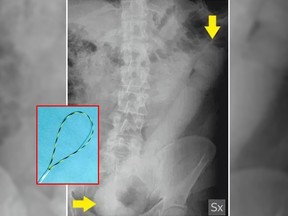 Italian doctors had to improvise and fashion a noose out of medical wire and a catheter tube in order to remove a sex toy embedded deep within a man's colon. (British Medical Journal)