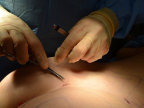 A surgeon performs buttock enhancement cosmetic surgery on September 10, 2012 in Beverly Hills, California. (Getty Images)