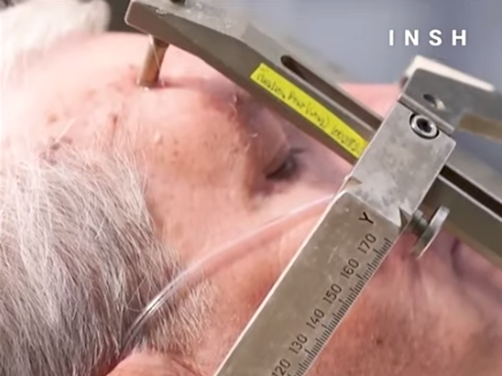 WATCH People drilling holes in their heads to treat addiction