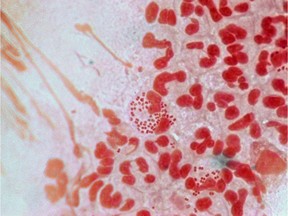 Drug resistant gonorrhea culture are shown under a microscope lens.