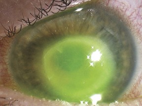 A case study of an unidentified English woman revealed she likely contracted a rare eye infection that almost blinded her after wearing her contact lens in the shower and while swimming.