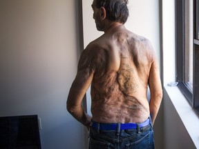 Victor Carboni bears the scars of the severe road rash that had torn broad swaths of skin from his hips, back, shoulders, ear, scalp and face. Skin grafts from his legs were needed to replace what had been torn from the rest of his body. (Ashley Fraser/Postmedia Network)