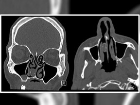 Doctors found a balloon filled with marijuana lodged up the nose of an Australian man. (British Medical Journal)