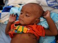 In this Oct. 28, 2017, file photo, Halima, 1, a Rohingya refugee boy, receives treatment for pneumonia in the Red Cross emergency hospital near Kutupalong refugee camp near Cox's Bazar, Bangladesh.