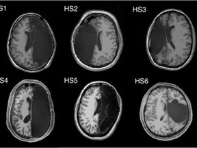 Brain scans released by the California Institute of Technology depict how six people can live with only half a brain. (Caltech Brain Imaging Center)